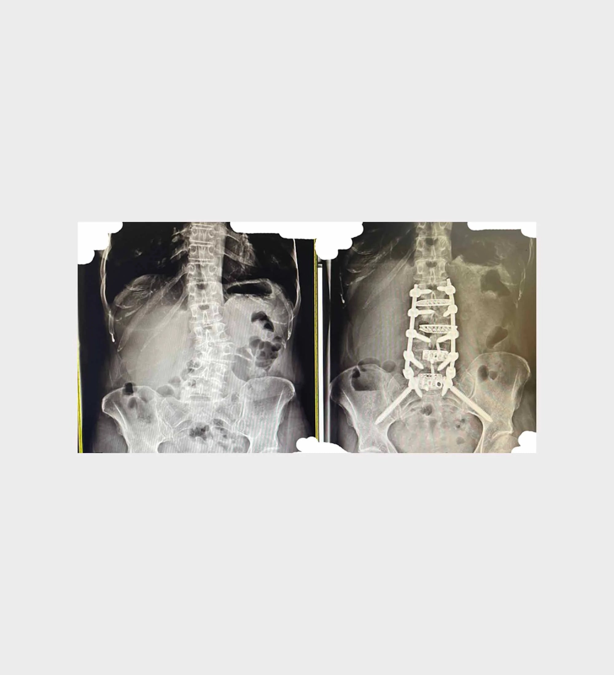 Spine X-ray (custom art) 55